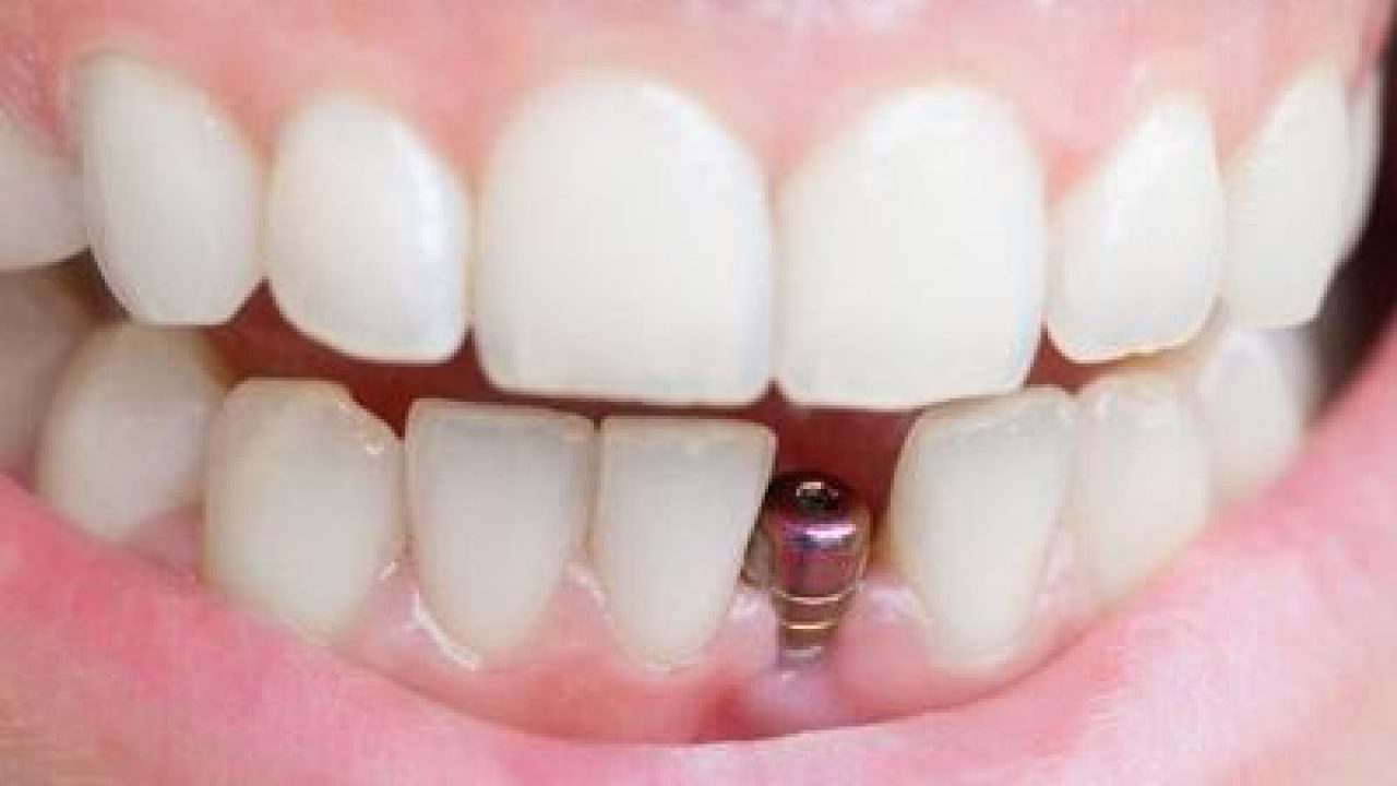 public/uploads/2021/07/How-Long-Do-Dental-Implants-Last.jpg