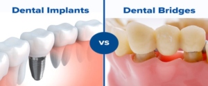 Dental Bridges and Implants