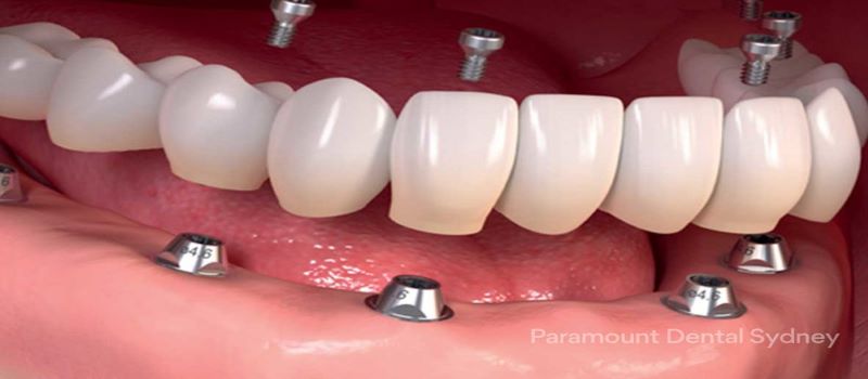 public/uploads/2022/10/Dental-implants.jpg-800-350.jpg