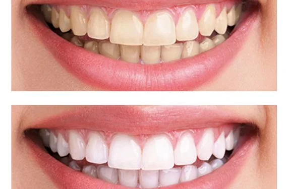public/uploads/2022/12/laser-teeth-whitening.webp
