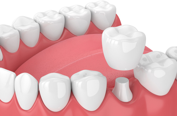 dental crown services