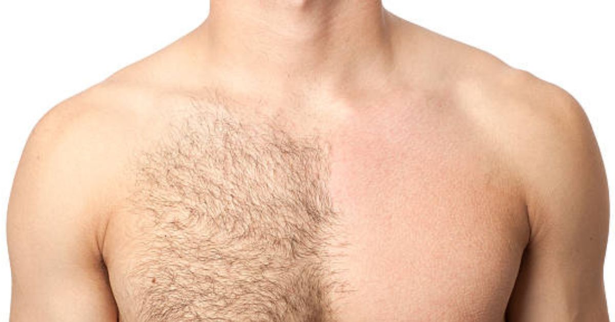 public/uploads/2023/08/Male-Hair-Removal.jpg